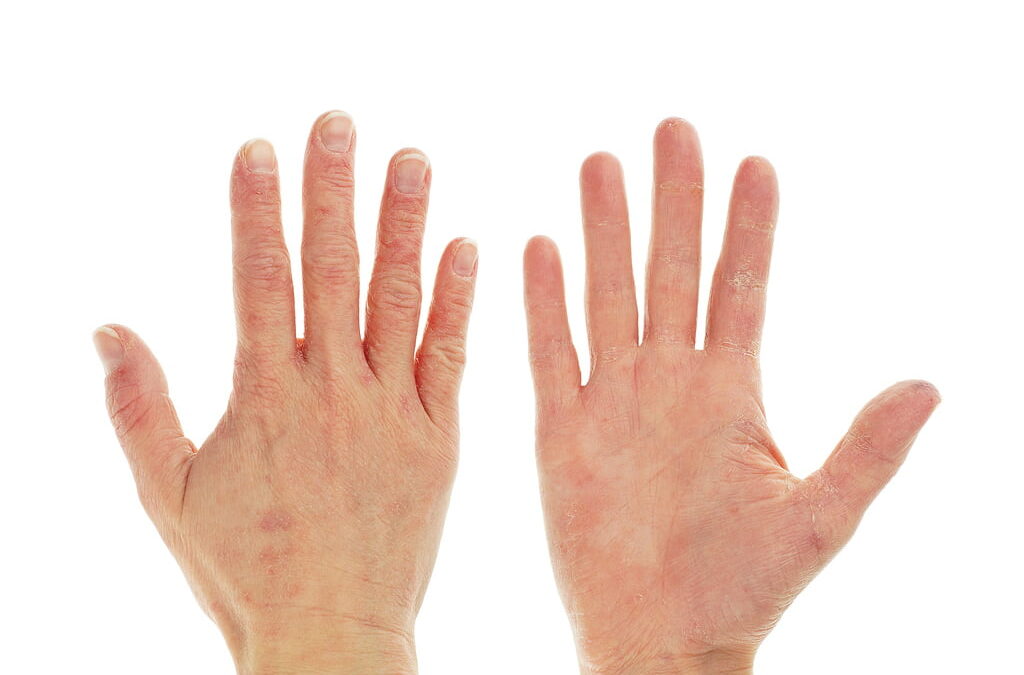 Take this Winter Hand Eczema Quiz!