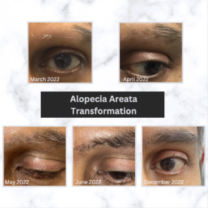 Results of eyebrow alopecia treatment, from bald patch to new hair 