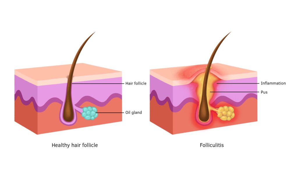 Folliculitis illustration showing normal vs. inflamed hair follicle