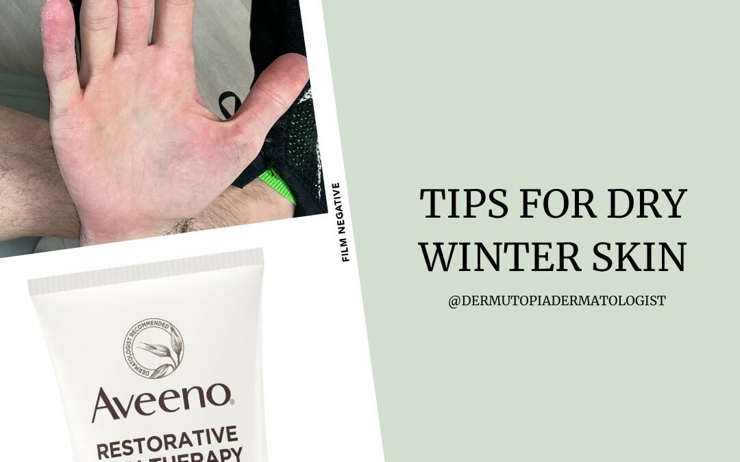 How To Prevent Dry Skin in Winter