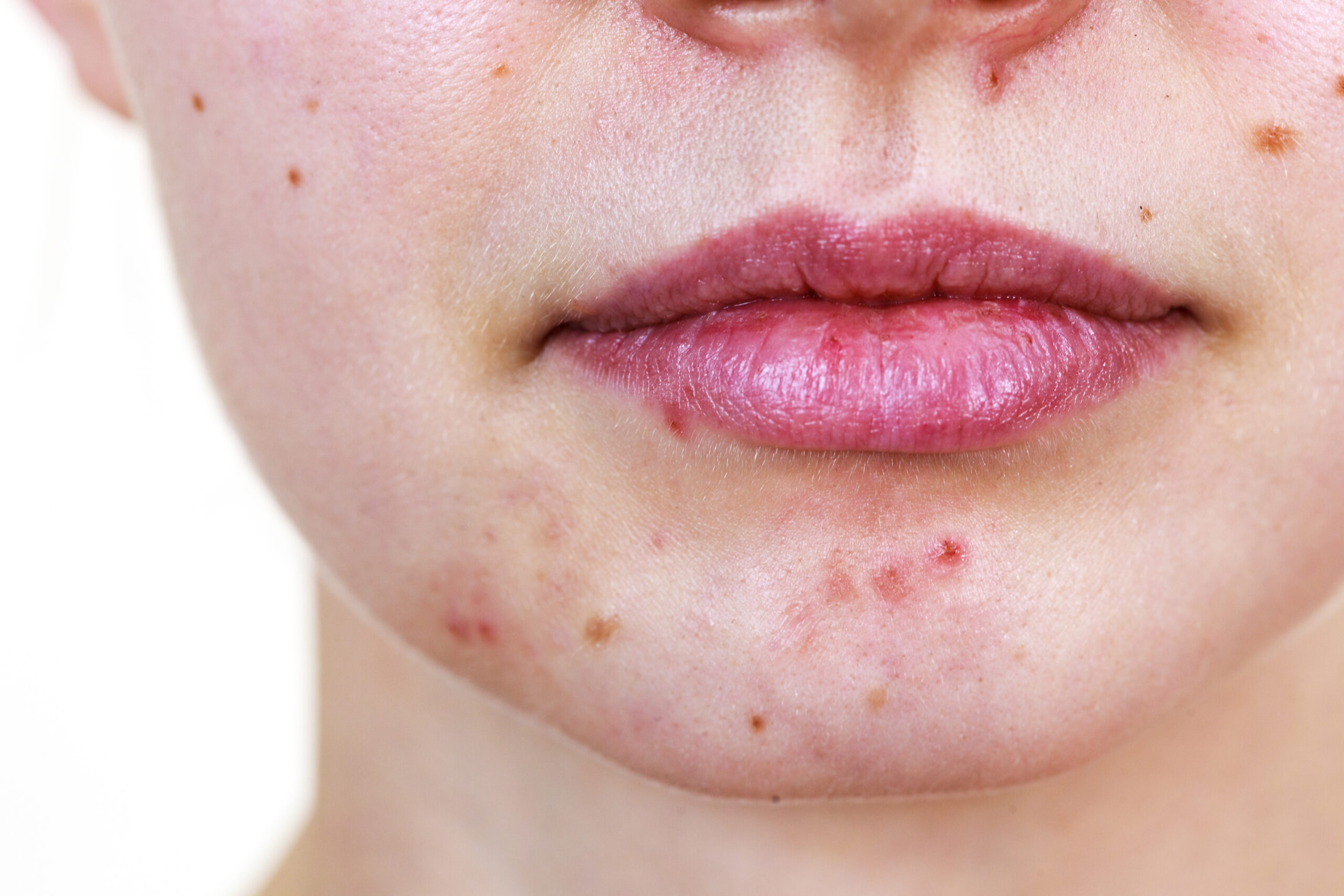 Female face with acne skin problem - Acne Treatment Vienna, VA - Dr. Brenda Dintiman