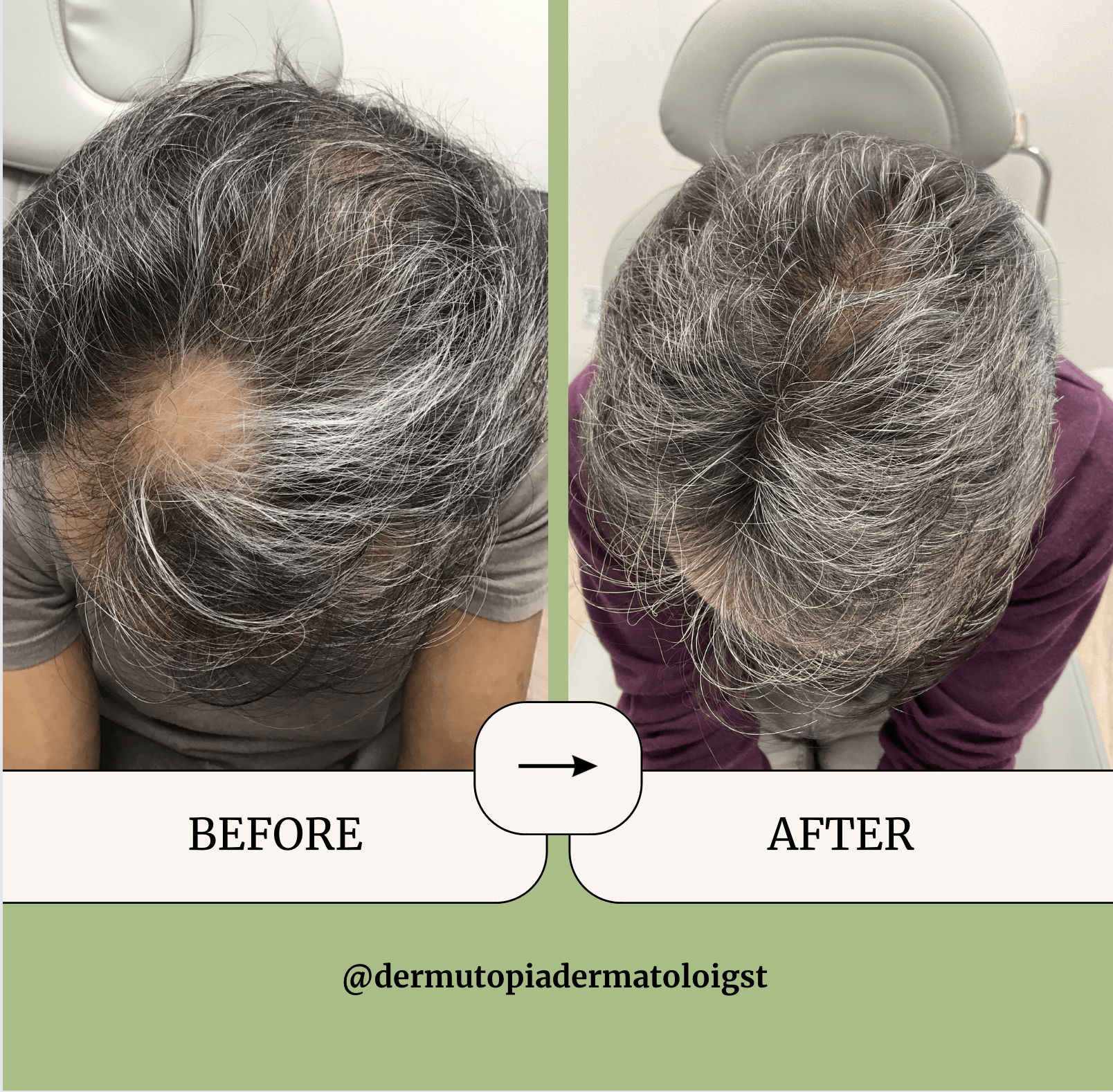 Hair Loss Treatment Before and After - DermUtopia