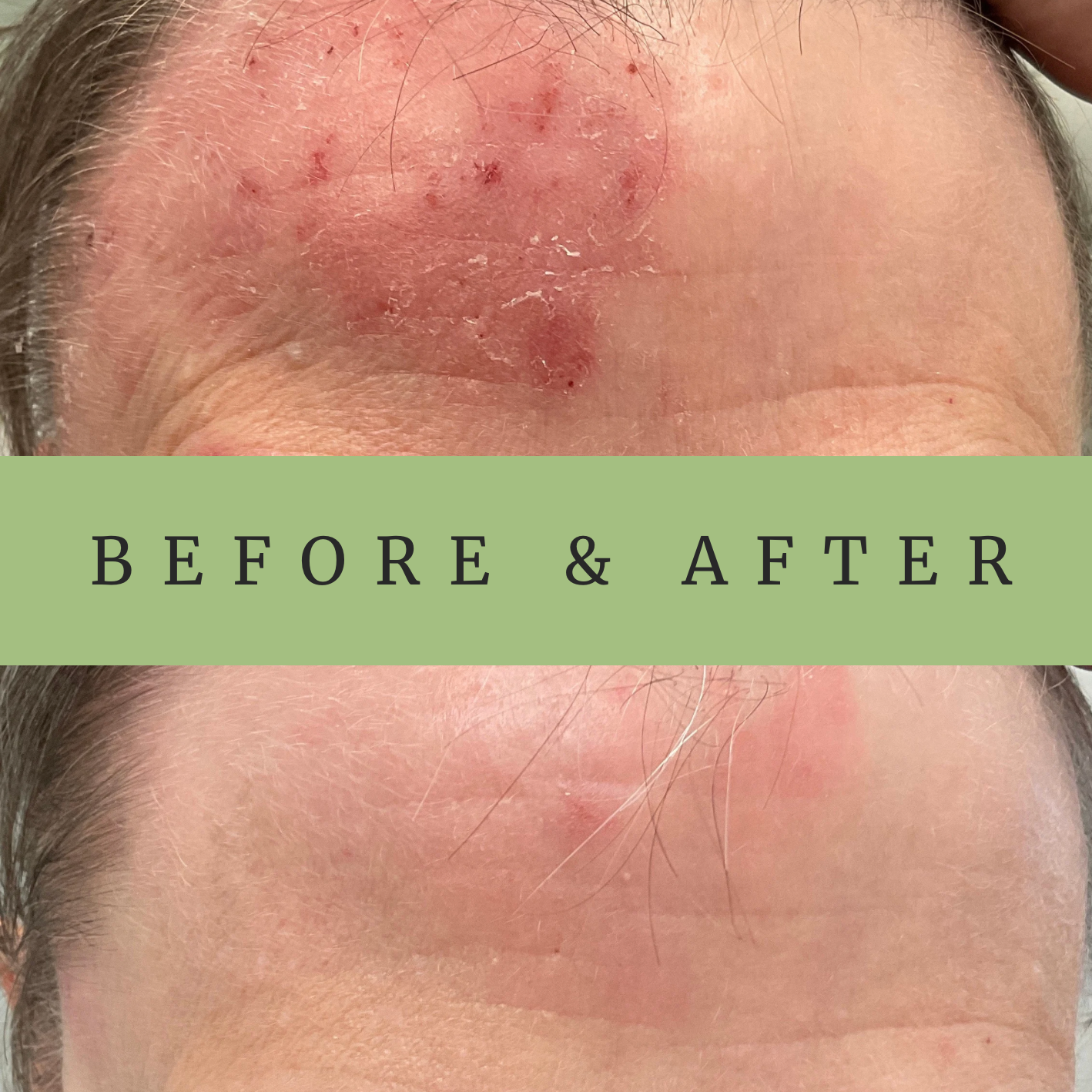 Eczema treatment before & after in Vienna, Virginia - Dr. Brenda Dintiman