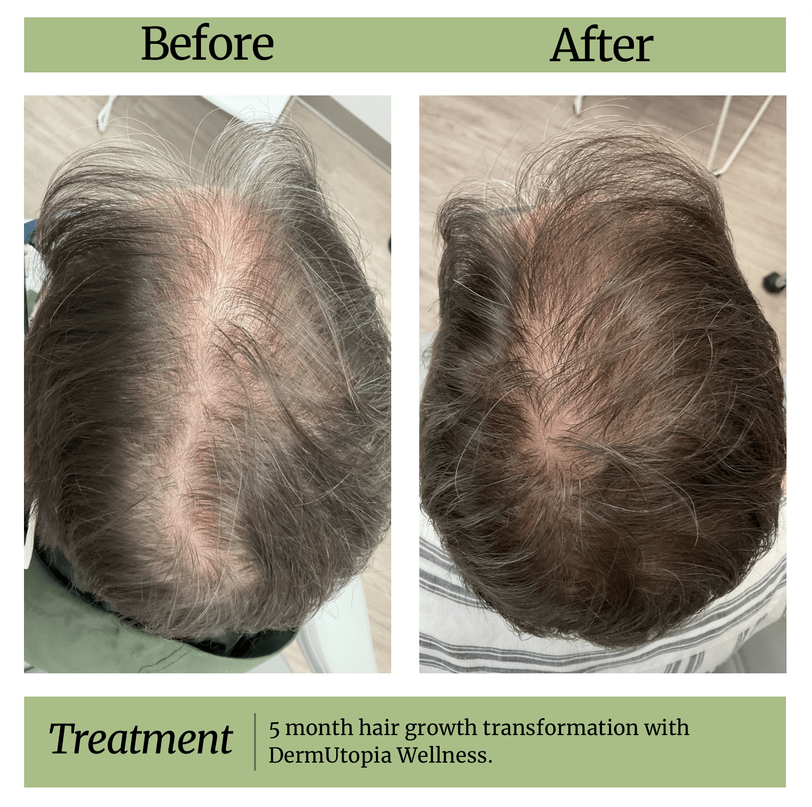 Hair Loss Treatment Before and After - DermUtopia