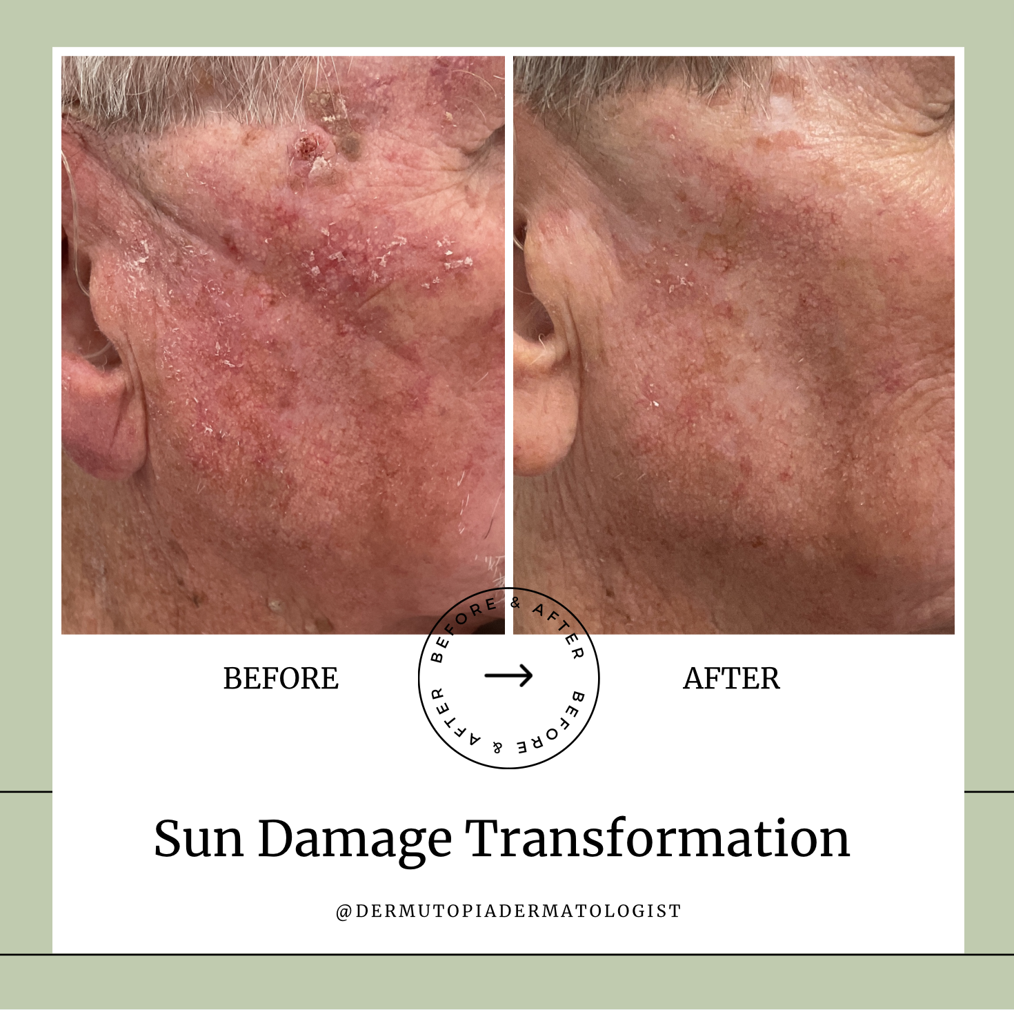 Treatment for Sun Damage - Skin Cancer Prevention - Dr. Brenda Dintiman