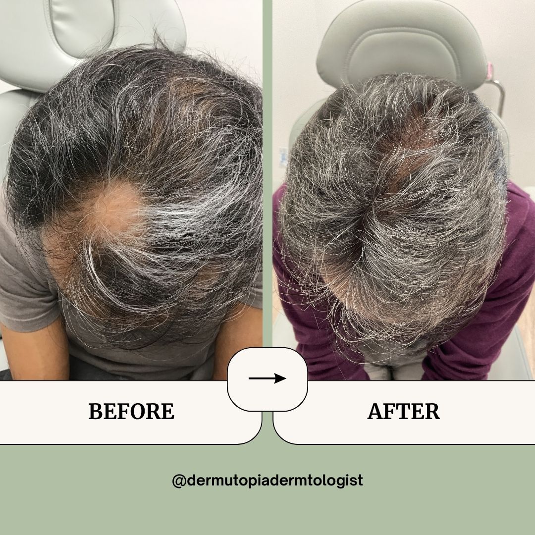 DermUtopia Before & After Hair Loss Treatment