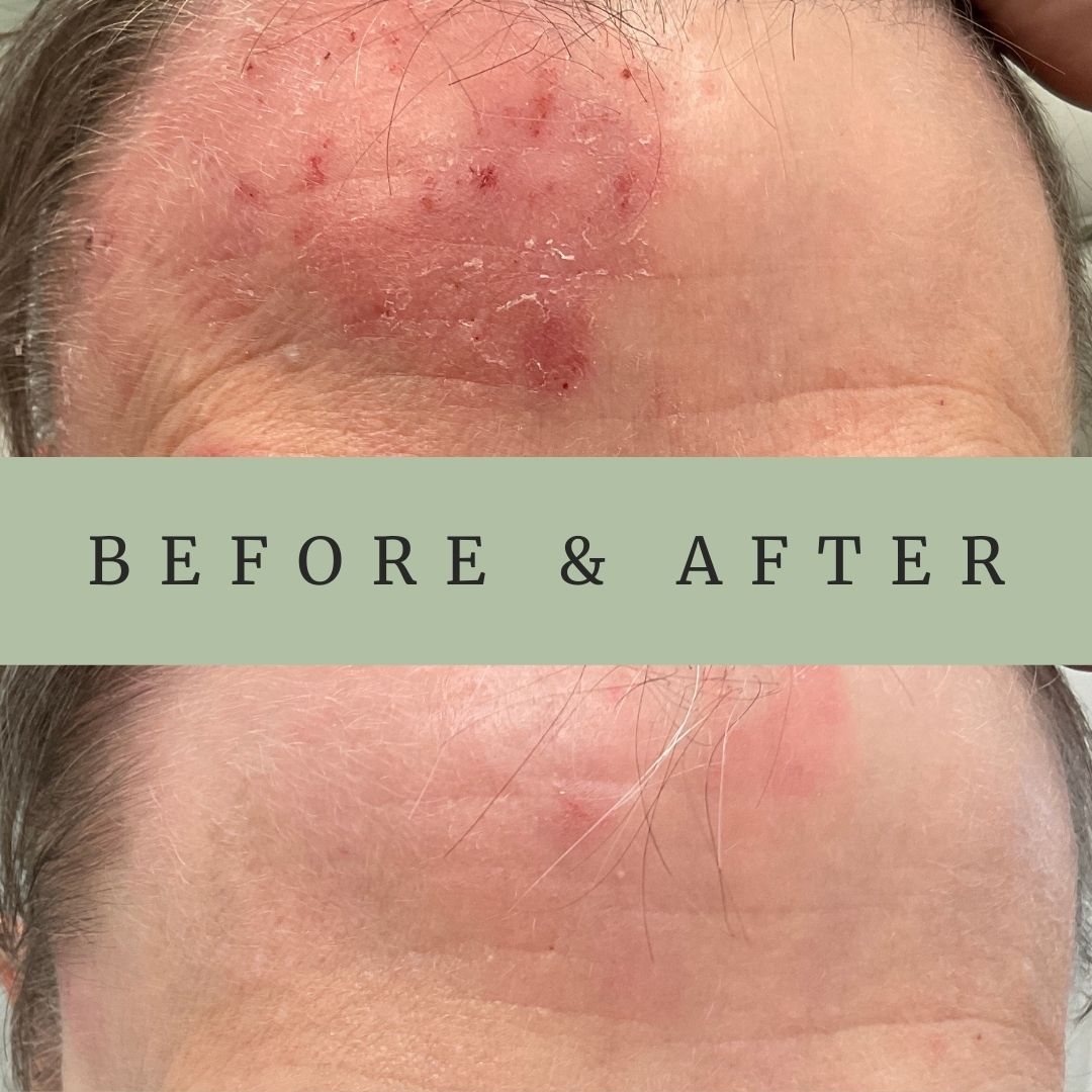 DermUtopia Before & After Medical Dermatology Treatment