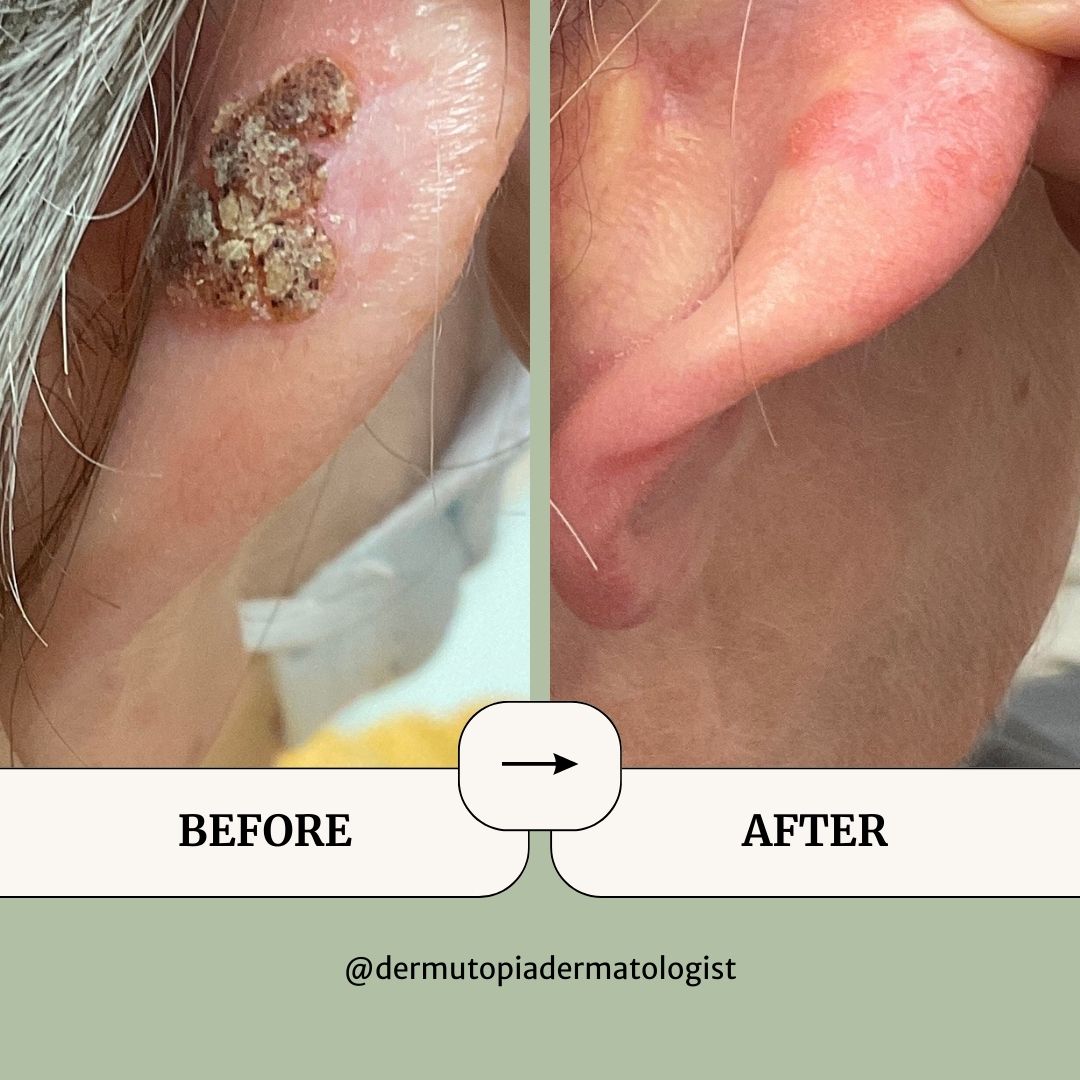 DermUtopia Before & After Medical Dermatology Treatment