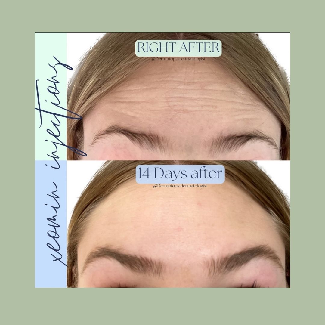 DermUtopia Before & After - Xeomin Injections post treatment