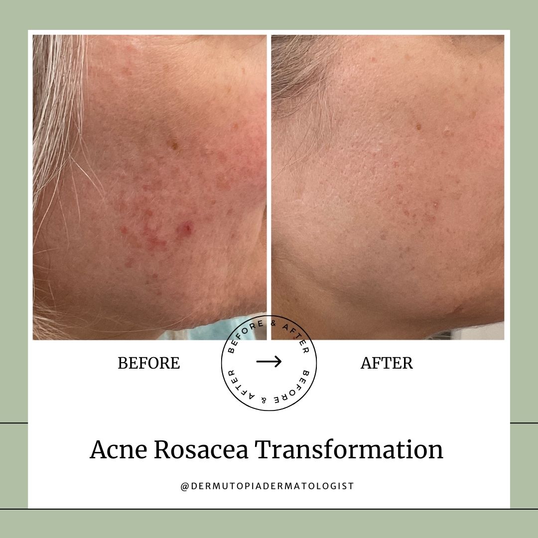 DermUtopia Before & After Ace Rosacea Transformation