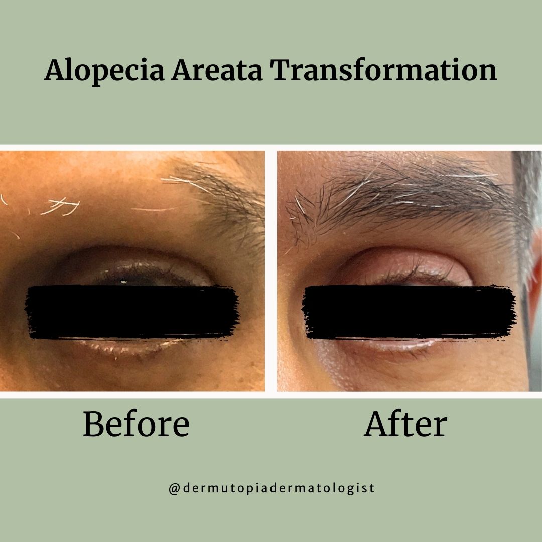 DermUtopia Alopecia Areata Transformation before and after