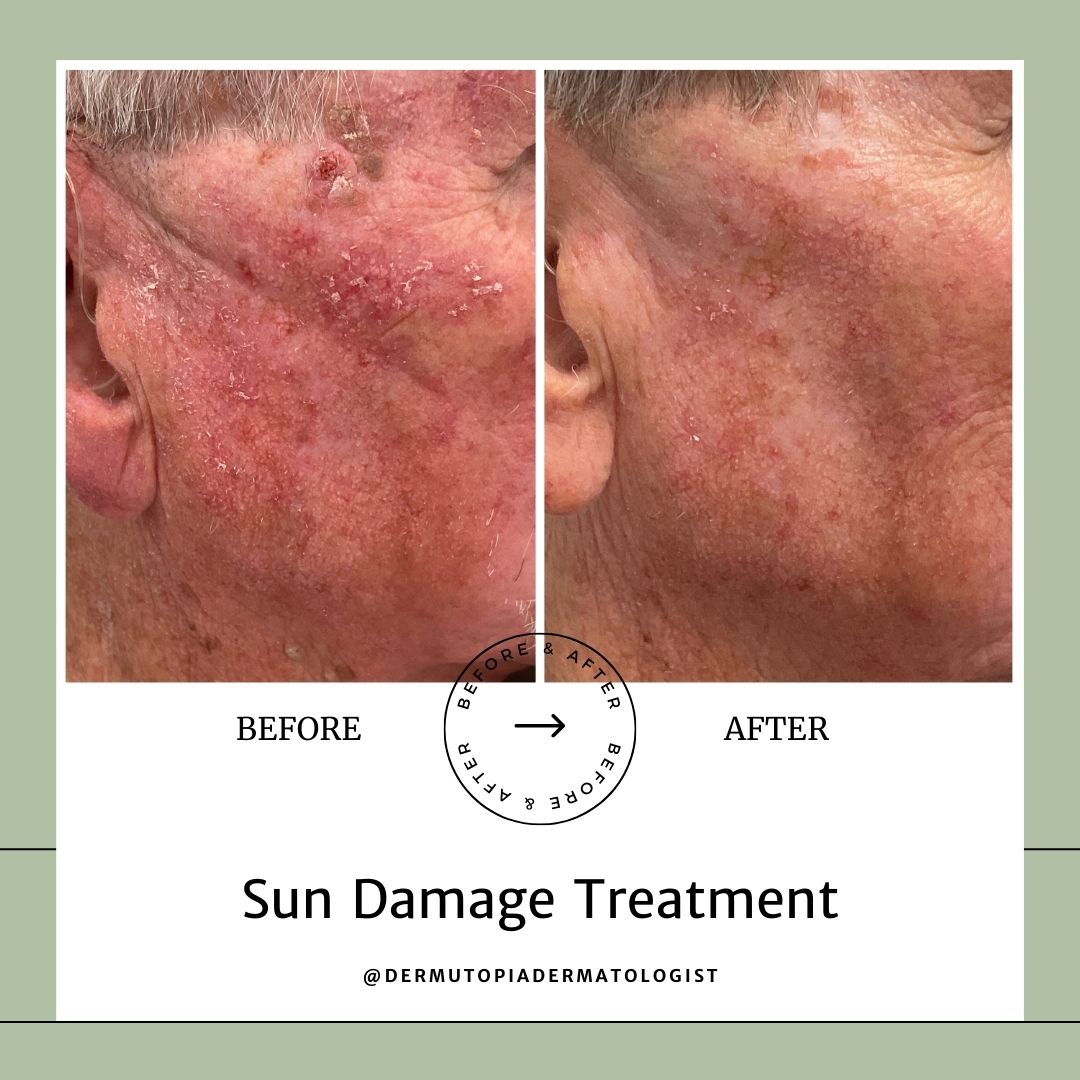 DermUtopia Sun Damage Treatment before and after