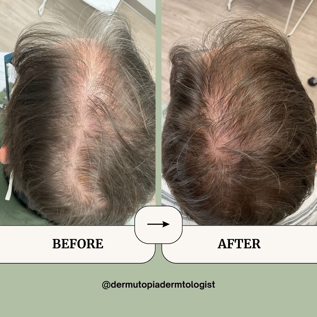 DermUtopia Before & After Hair Loss Treatment