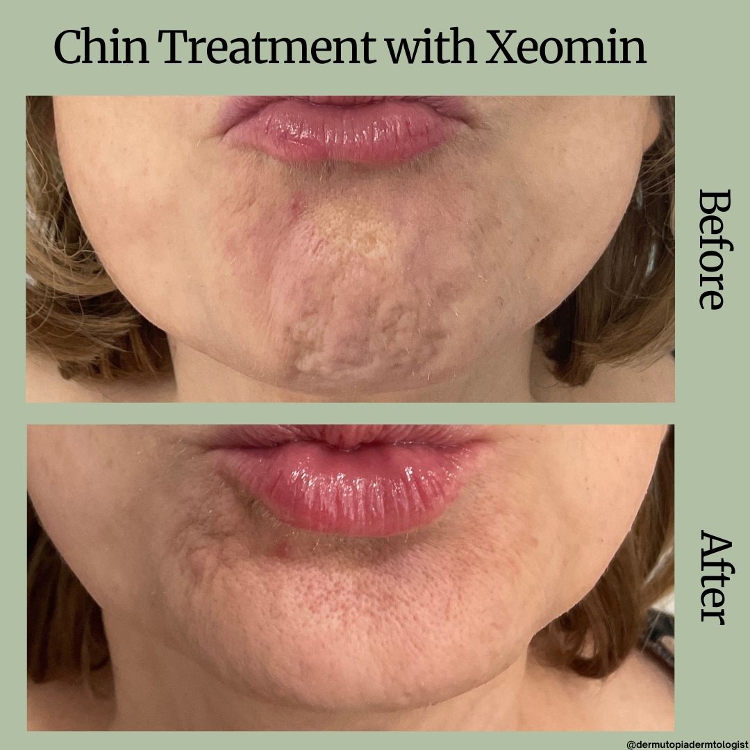 DermUtopia Before & After - Chin Treatment with Xeomin