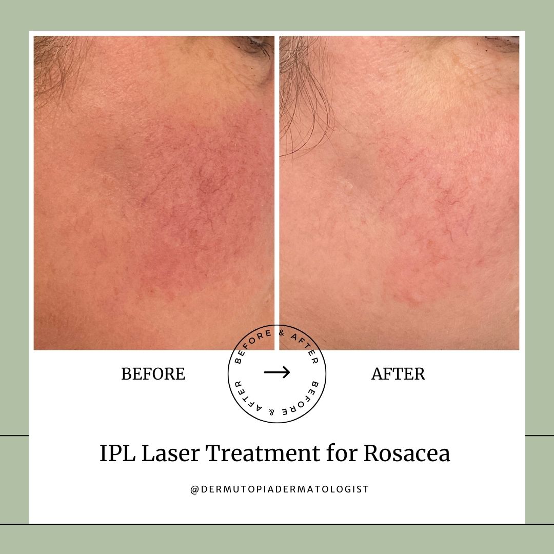 IPL Laser Treatment for Rosacea