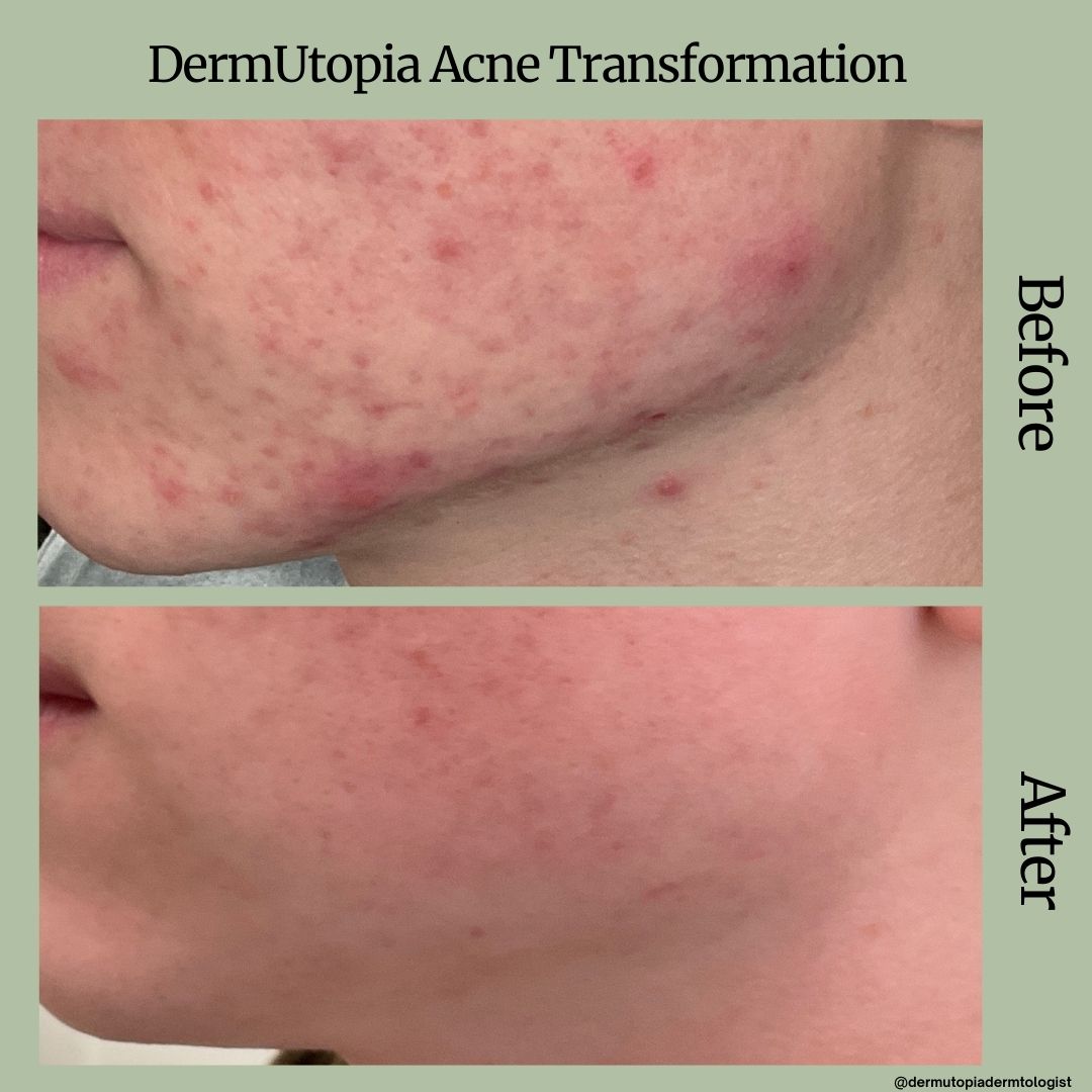 DermUtopia Before& After Acne Transformation - Acne Scar Treatment