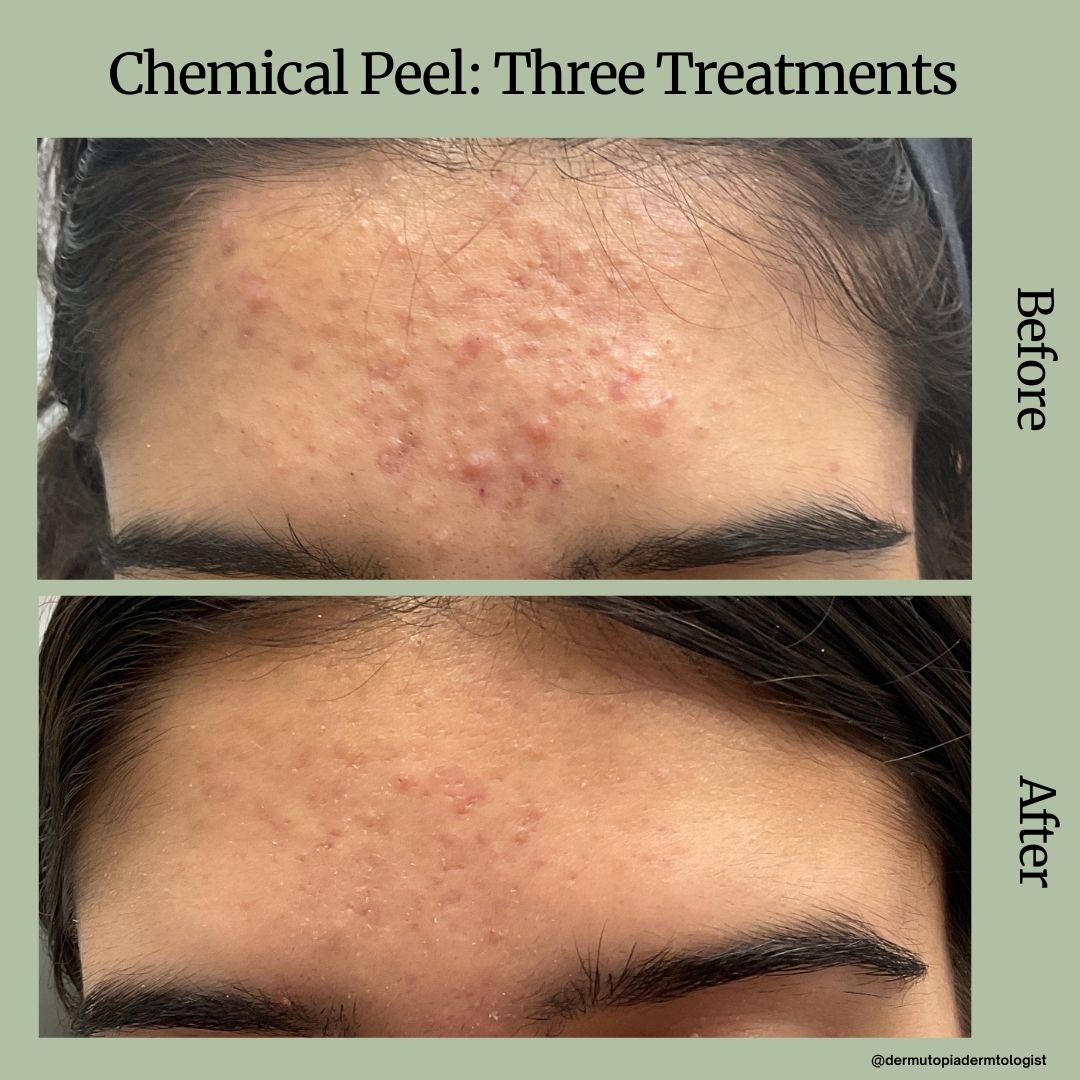 DermUtopia Before & After - Chemical Peel: Three Treatments