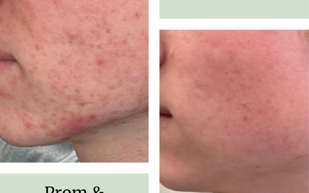 DermUtopia Acne Treatment for Prom, Graduation, and Vacation Season