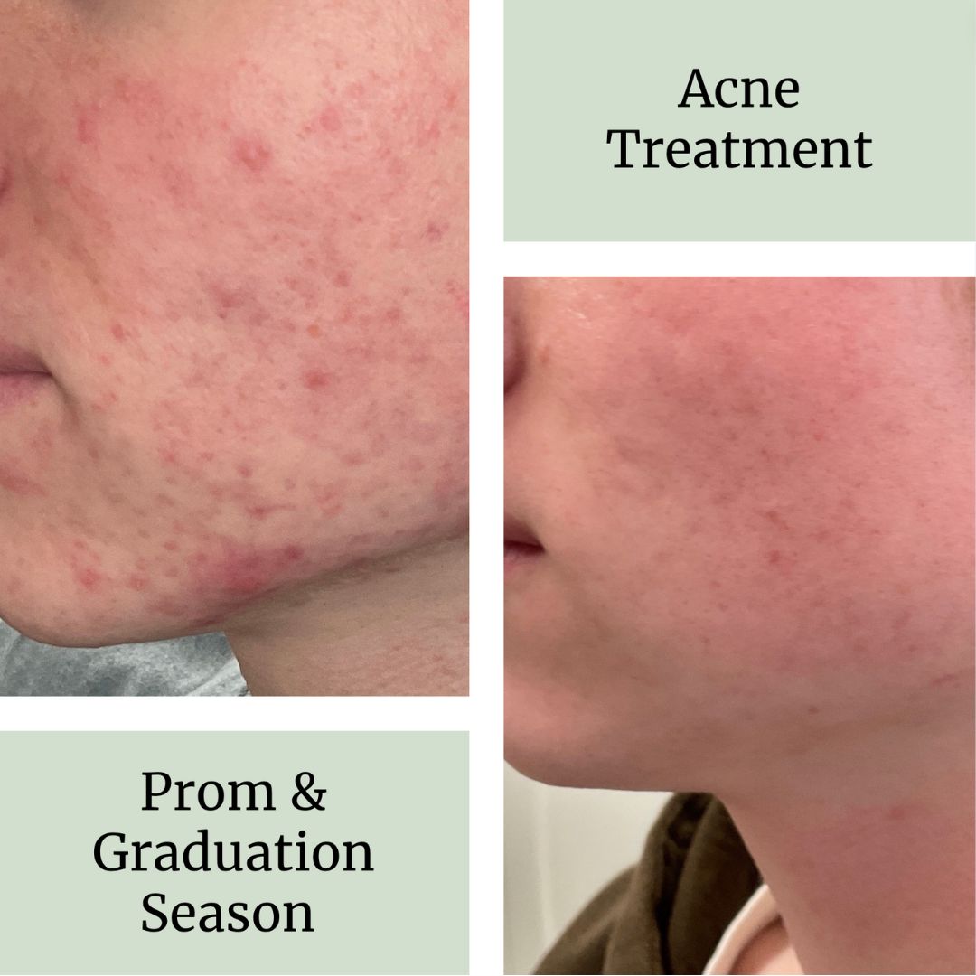 DermUtopia Acne Treatment for Prom, Graduation, and Vacation Season