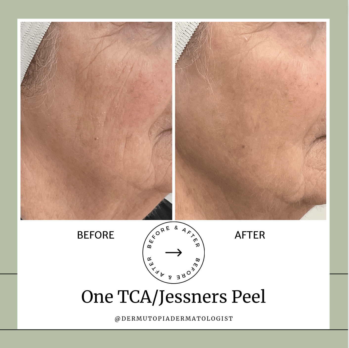 DermUtopia Before & After - One TCA/Jessners Peel