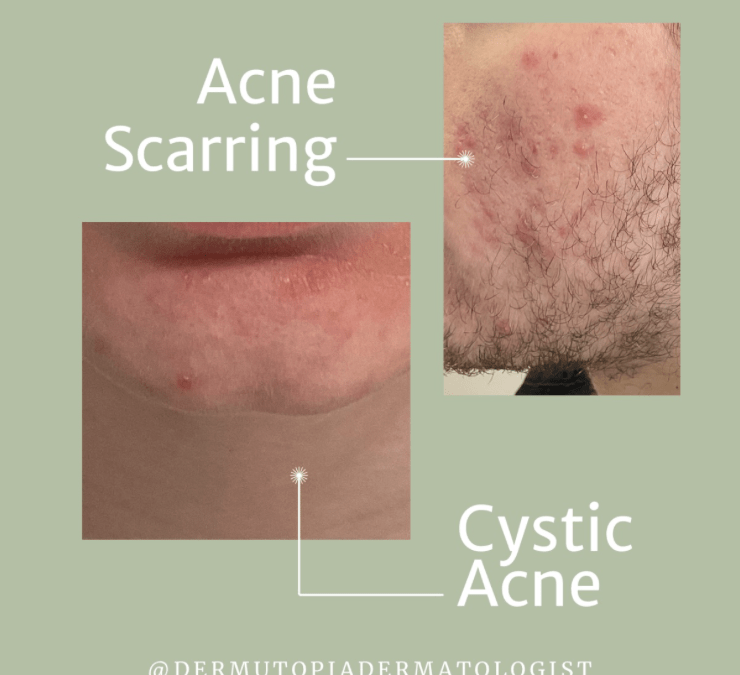 DermUtopia’s Guide to Acne Types