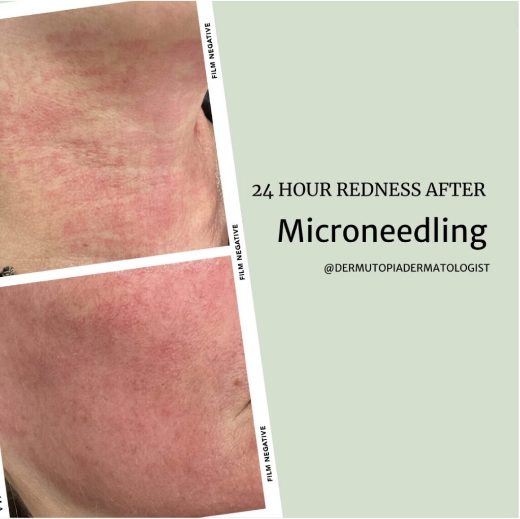 Should You Get RF Microneedling or SkinPen Microneedling?