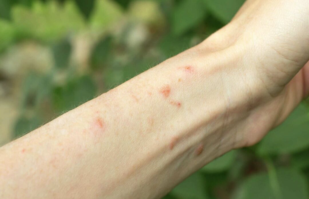 Garden Rashes