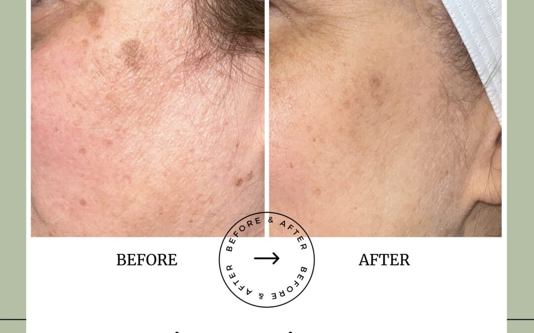 Laser Focused on Bright Ideas: Fading Hyperpigmentation the Smart Way