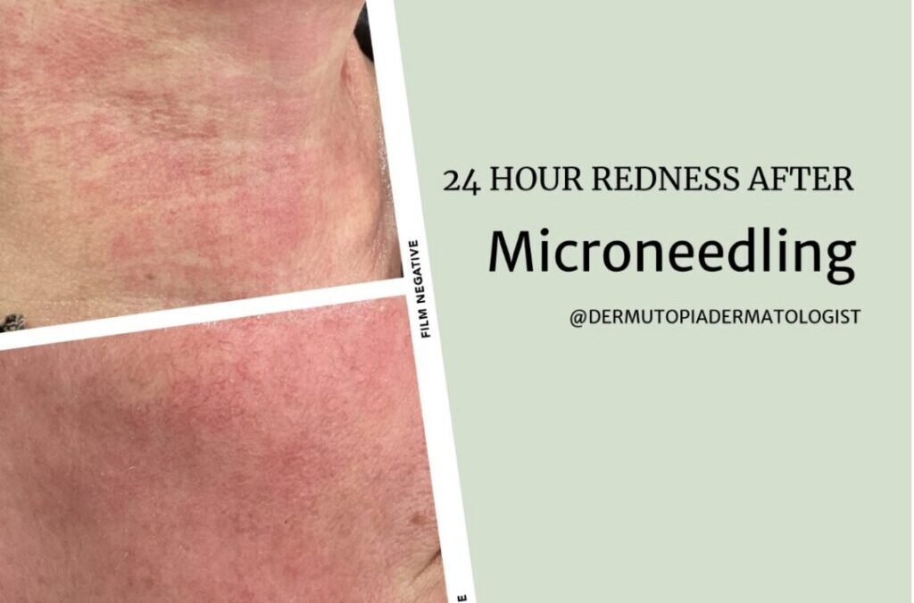 Should You Get RF Microneedling or SkinPen Microneedling?