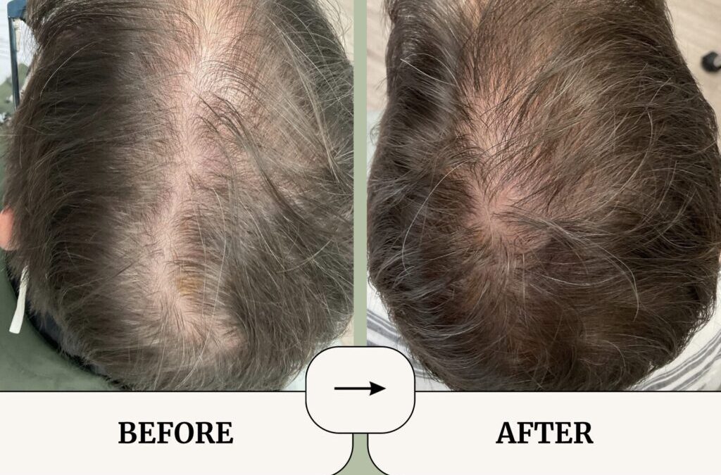 Low-Dose Oral Minoxidil for Hair Loss