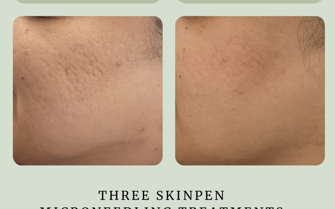 SkinPen Microneedling for Acne Scars