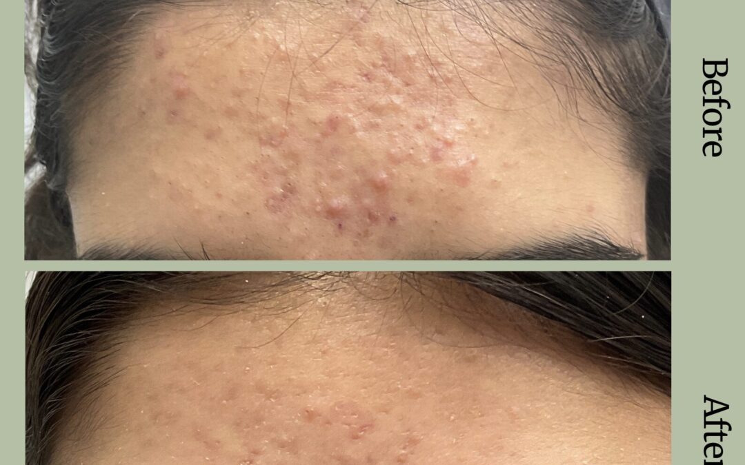 Summer Sweat and Breakouts? It Could Be Pityrosporum Folliculitis.